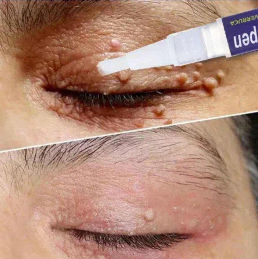 Zakdaviβ’ Warts Remover Original Cream β Fast, Safe & Effective Skin Solution ππ‘οΈ