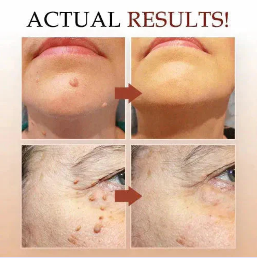 Zakdaviβ’ Warts Remover Original Cream β Fast, Safe & Effective Skin Solution ππ‘οΈ