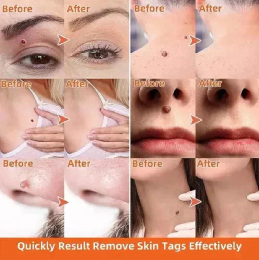 Zakdavi™ Warts Remover Original Cream – Fast, Safe & Effective Skin Solution 🌟🛡️