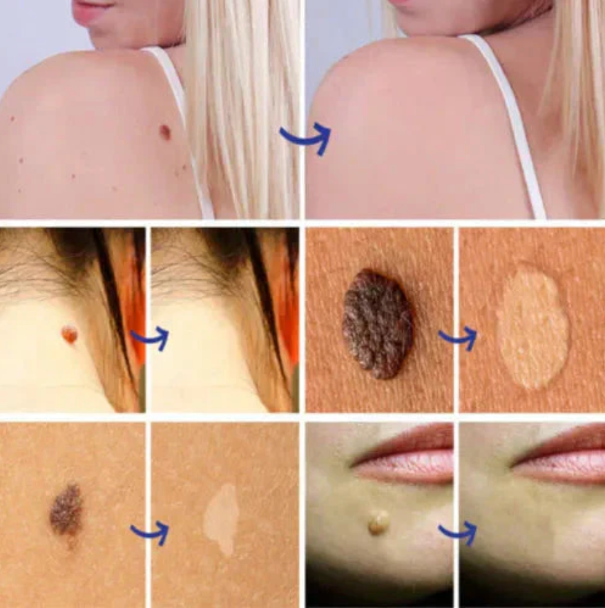 Zakdavi™ Warts Remover Original Cream – Fast, Safe & Effective Skin Solution 🌟🛡️