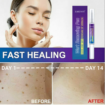 Zakdavi™ Warts Remover Original Cream – Fast, Safe & Effective Skin Solution 🌟🛡️